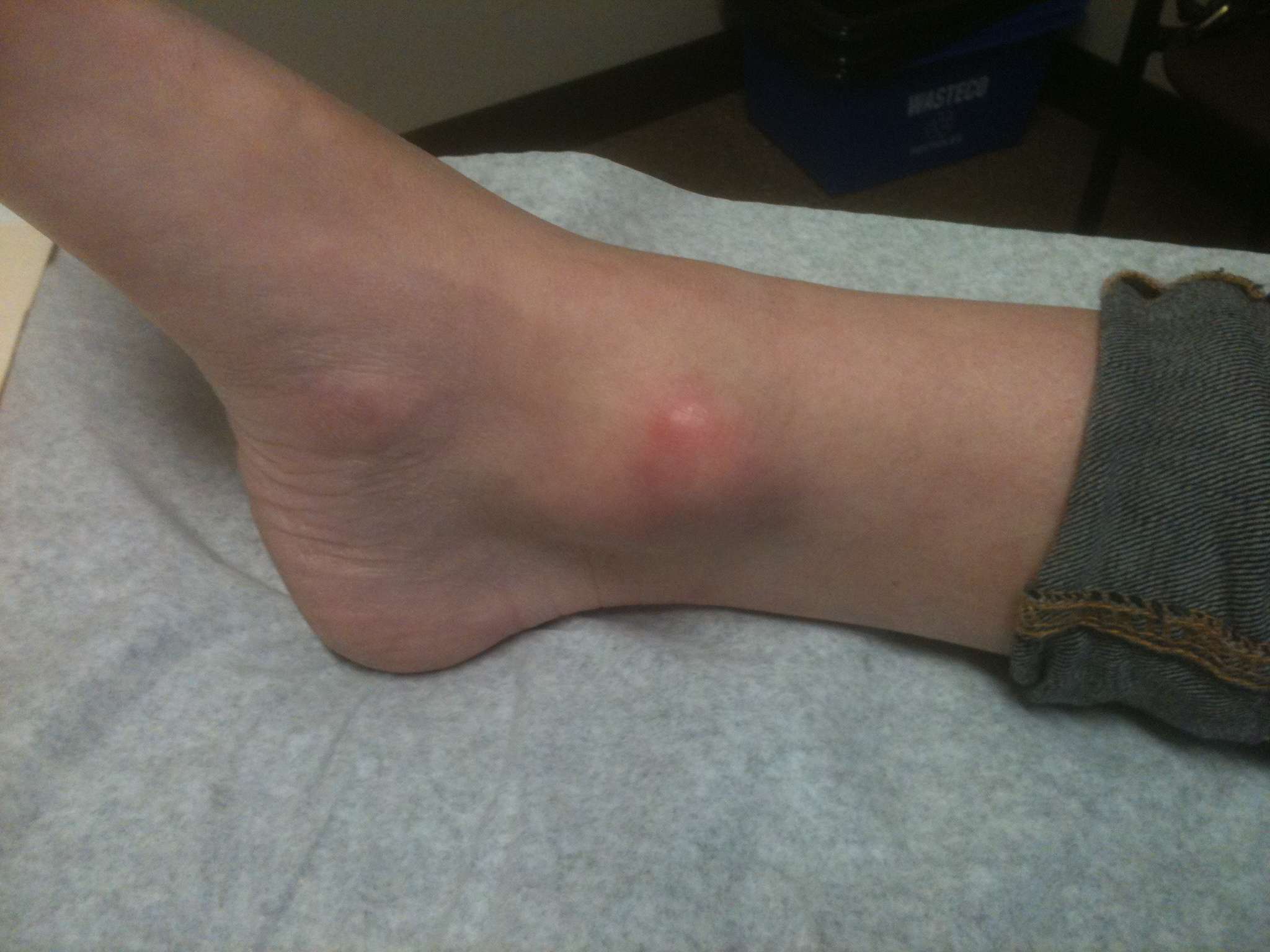 Ankle Giant Cell Tumour